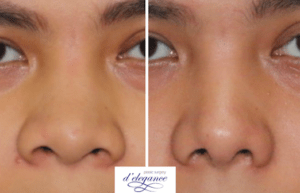Membuat hidung menjadi ramping