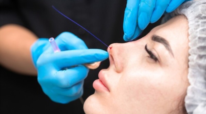nose threadlift